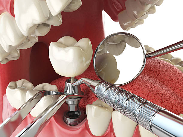 Best Emergency Denture Repair in Gloucester, MA